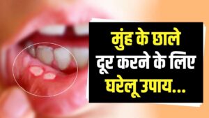 Remedies for Mouth Ulcers